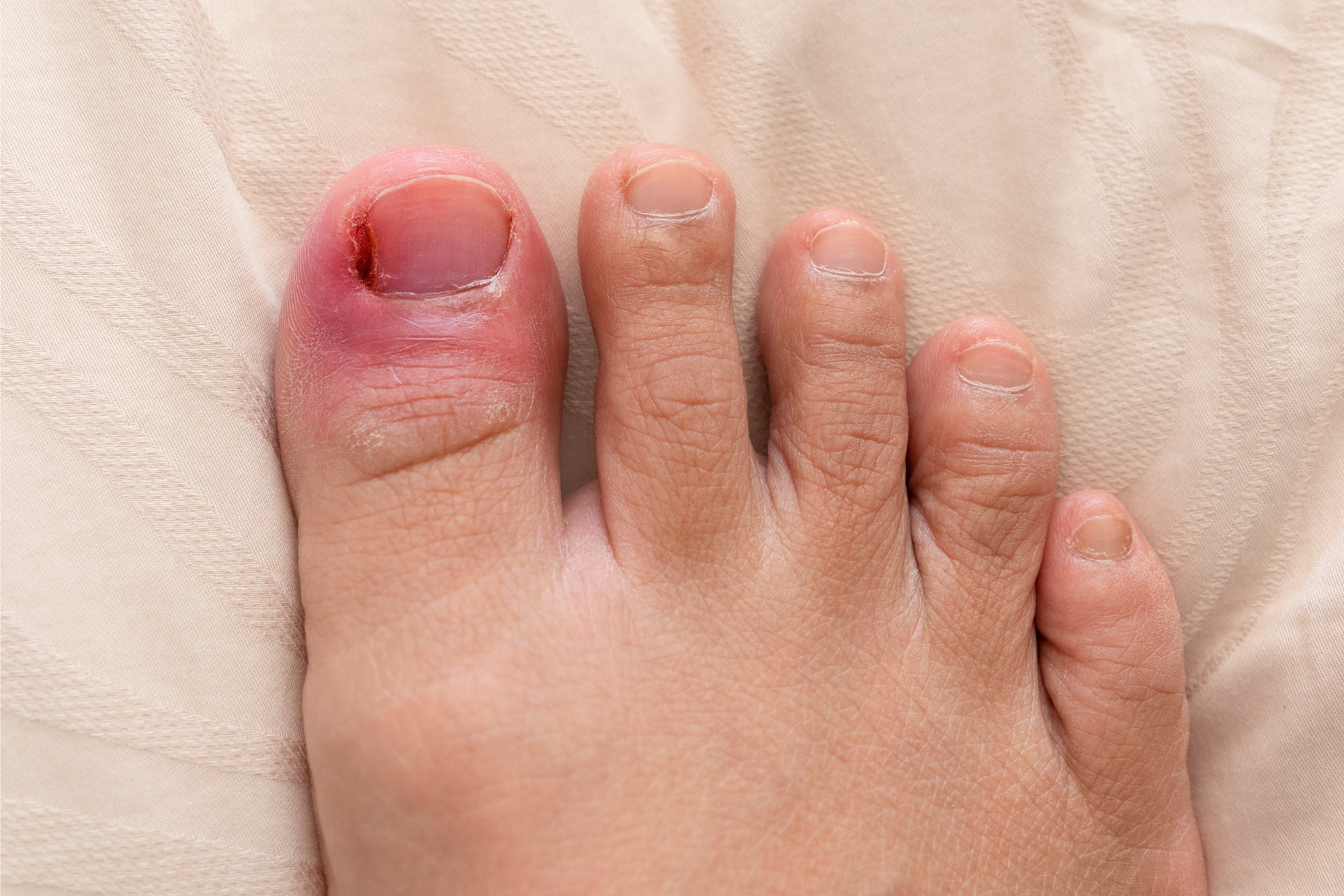 Ingrown Toe Nails Andover Podiatry Clinic