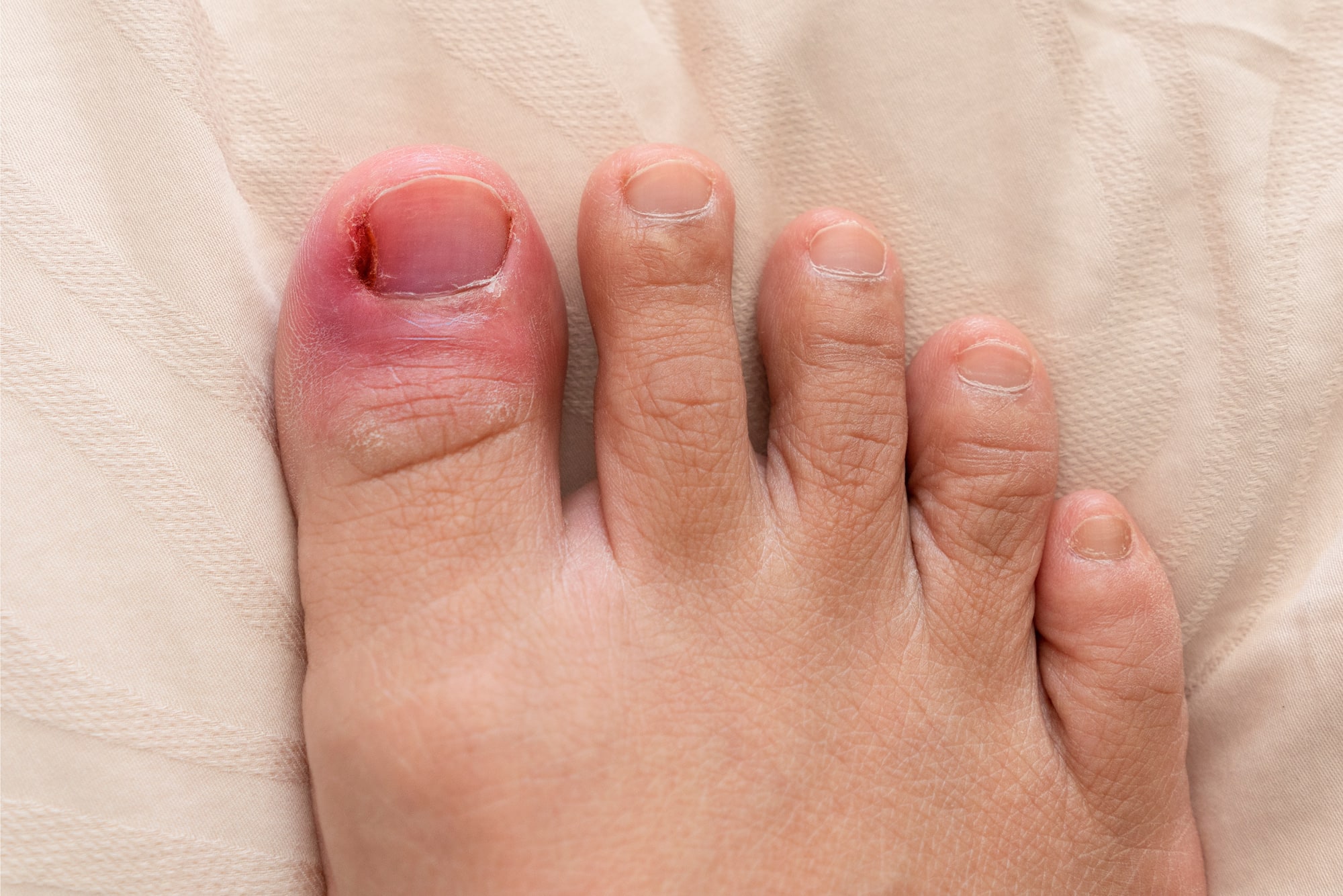 Ingrown Toe Nails - Andover Podiatry Clinic